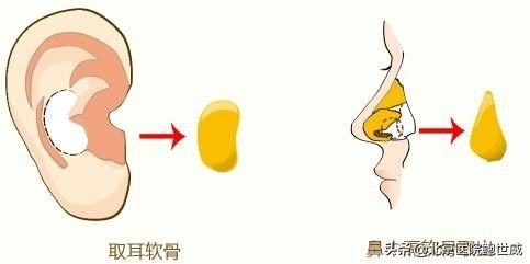 软骨隆鼻多少钱