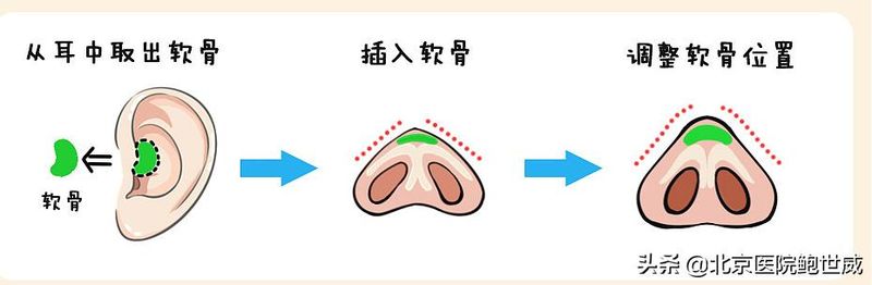 软骨隆鼻多少钱