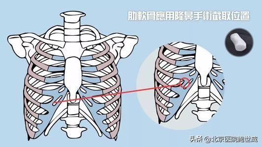 软骨隆鼻多少钱
