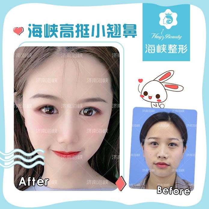 软骨隆鼻多少钱