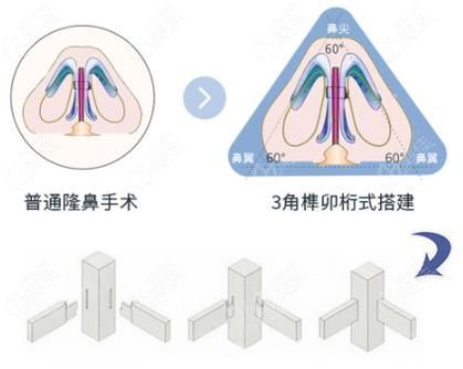 软骨隆鼻多少钱