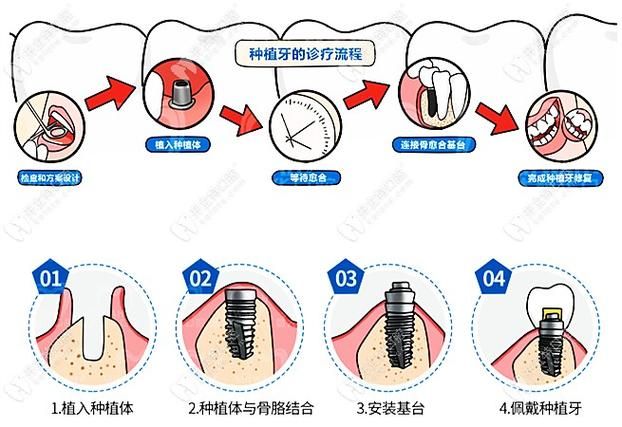 种牙的步骤图解