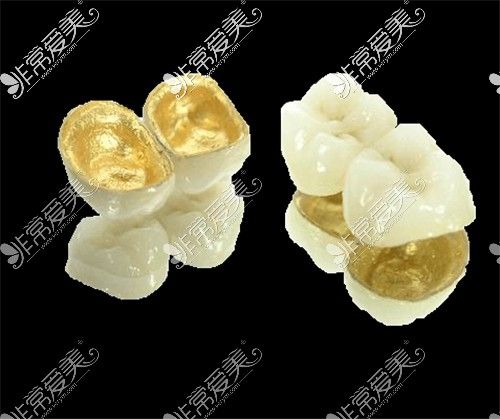 烤瓷牙牙套多少钱一颗