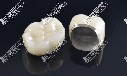 烤瓷牙牙套多少钱一颗