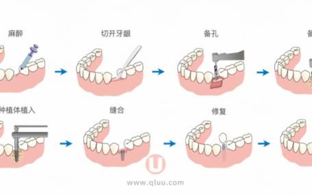 A step map to grow teeth