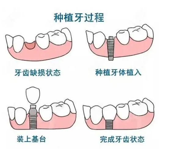 A step map to grow teeth