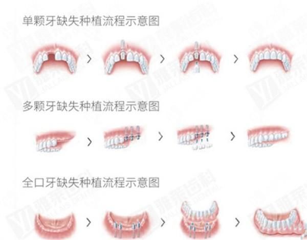 A step map to grow teeth