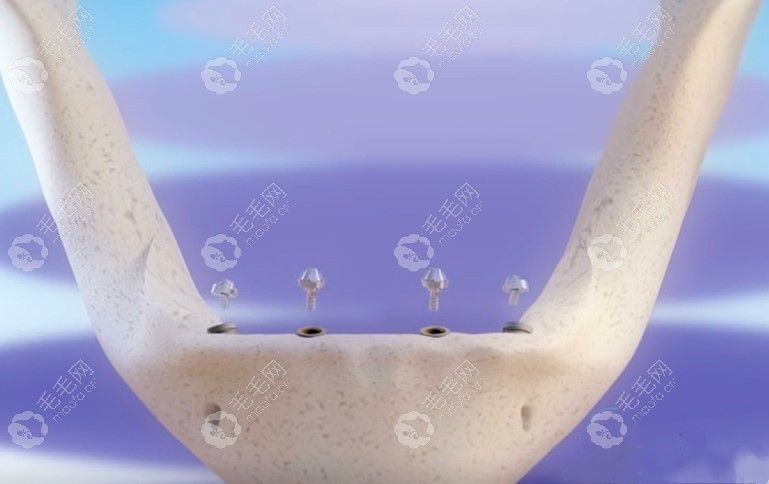 种牙的步骤图解